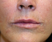 Feel Beautiful - Lip Lines (fine creases around lips) - After Photo